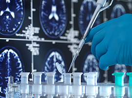 Patienternas röst om ny alzheimerbehandling