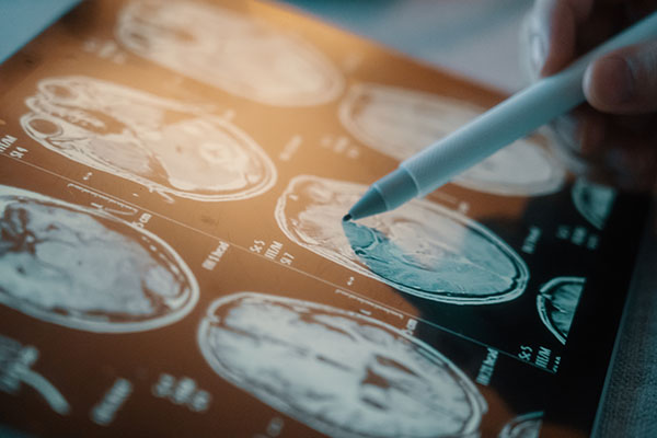 Ny hjärnavbildningsteknik kan upptäcka tidig frontallobsdemens